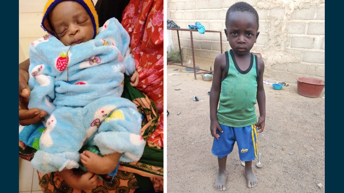 Sur la gauche, photo de Moussa Sandwidi encore bébé, avec ses deux pieds repliés vers l'intérieur. Sur la droite, photo de Moussa Sandwidi âgé de 3 ans qui se tient debout tout seul et n'a plus de malformation aux pieds après la correction de son pied bot.