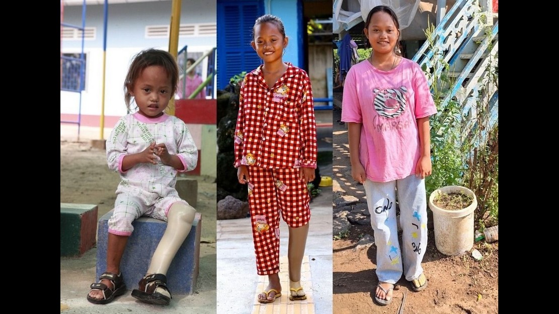 Au Cambodge, la même petite fille sur trois photos à différents moments de sa vie entre 2 et 14 ans. Elle porte une prothèse à sa jambe gauche.
