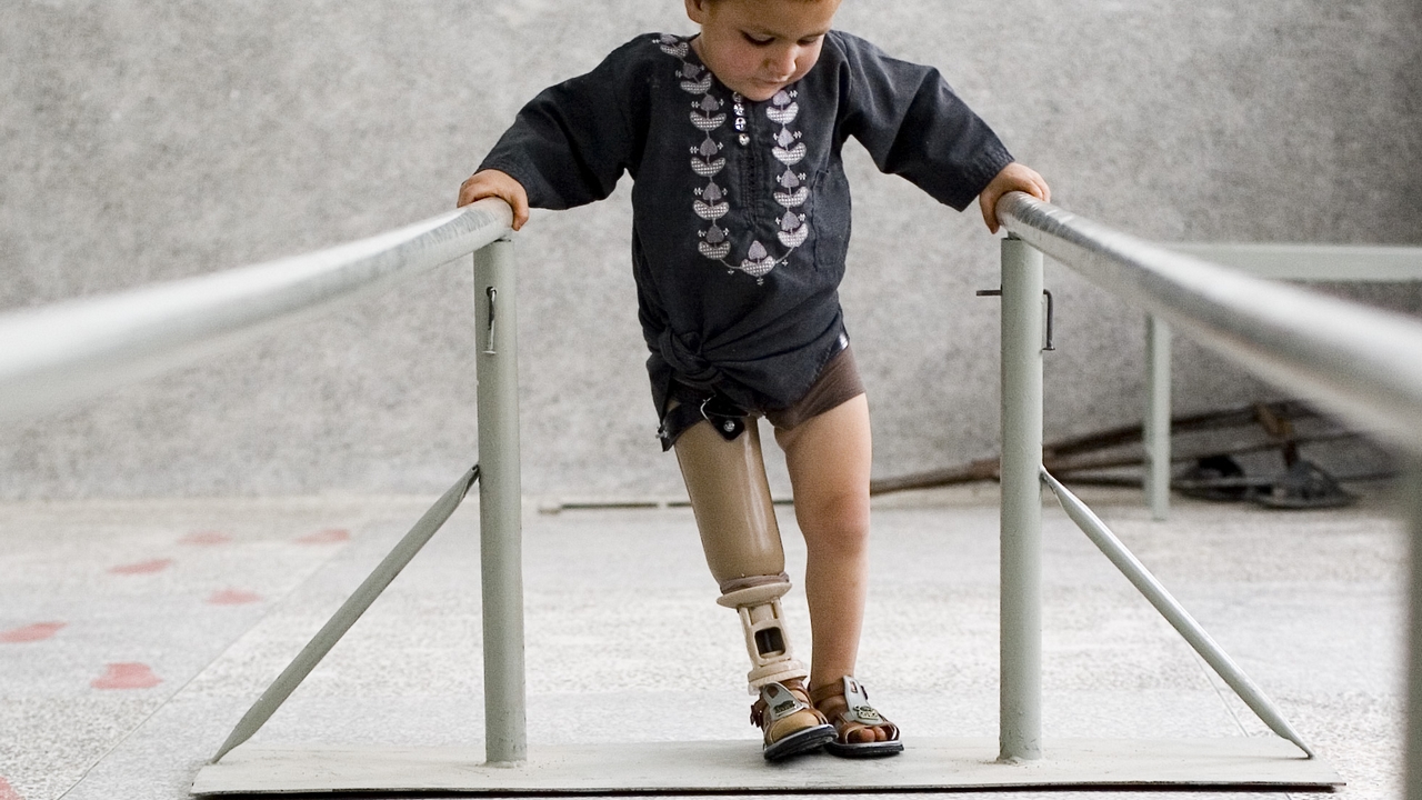 Afghanistan - Naseer, 3 ans, victime de la guerre en Afghanistan, essaye sa première prothèse fournie par Handicap International.