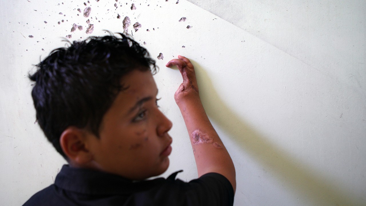 Mohamed jouait au football avec ses amis lorsqu’un objet brillant attira son attention. Il commença à jouer avec, c’était une sous-munition qui explosa. Des fragments furent projetés sur plusieurs mètres. L’enfant a été touché à la main et au visage.